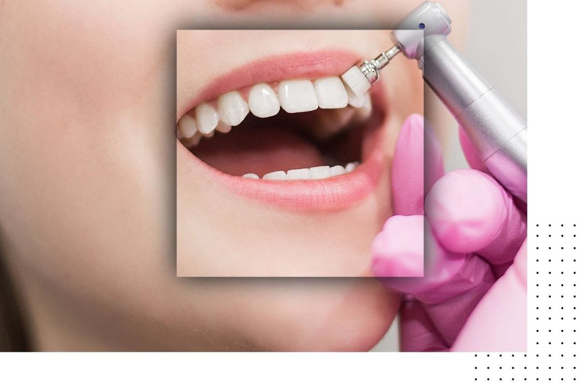 How Is Teeth Whitening Process Done? Kadıköy Estetik Diş